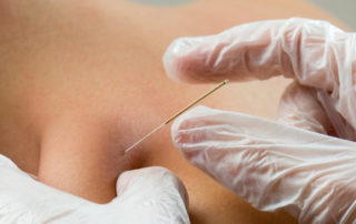 Dry Needling